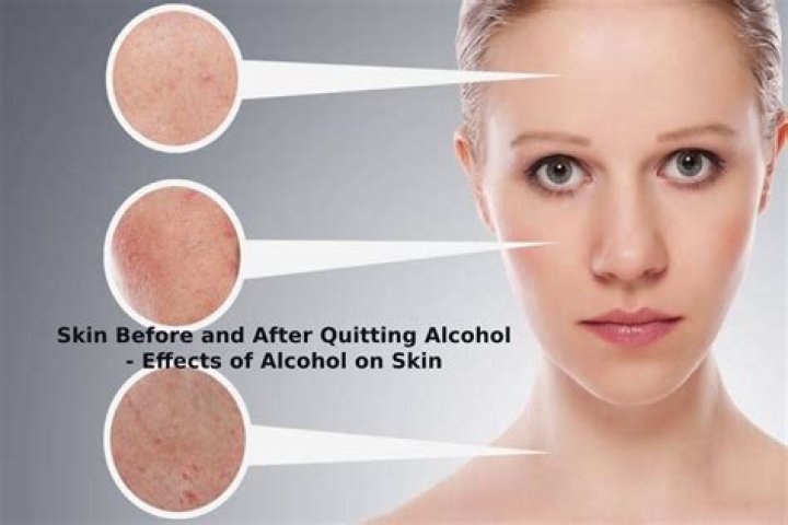 Alcohol effects on skin