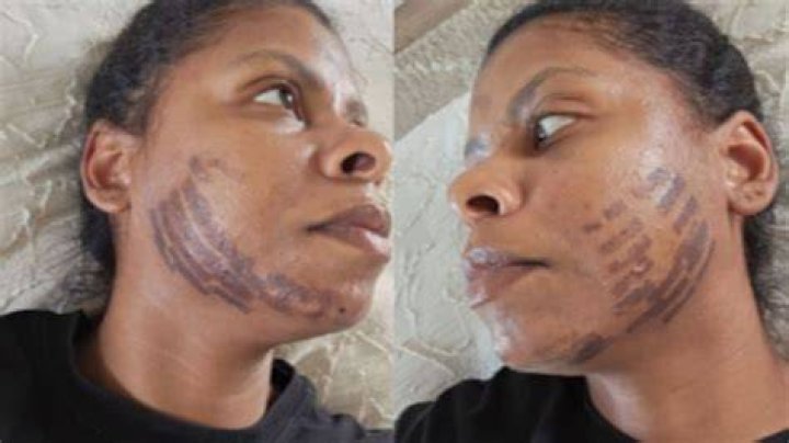 An Auckland woman was burnt during her laser hair removal session. Photo / Supplied