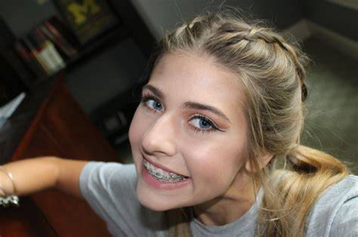 Braces Girl 