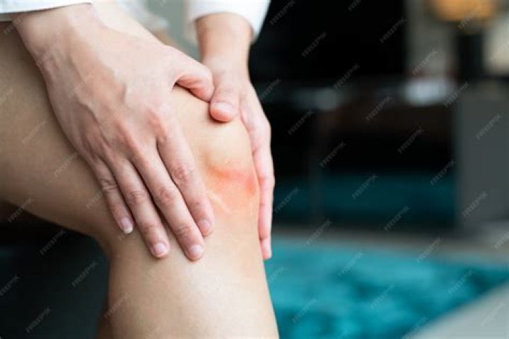 bruised knee of Asia woman, selective focus bruised knee of asia woman, selective focus