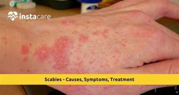 Can Scabies Live In Your Shoes - Everything You Need to Know