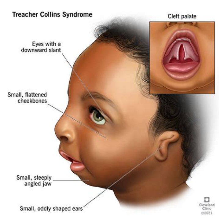 Causes of treacher Collins syndrome MEDizzy