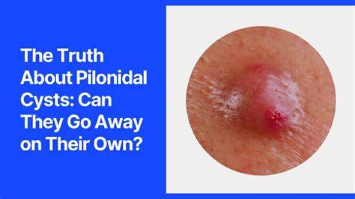 cyst pop looks like explosion 
