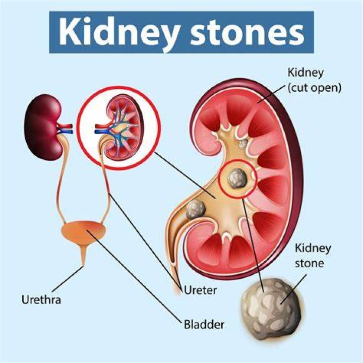 kidney stones