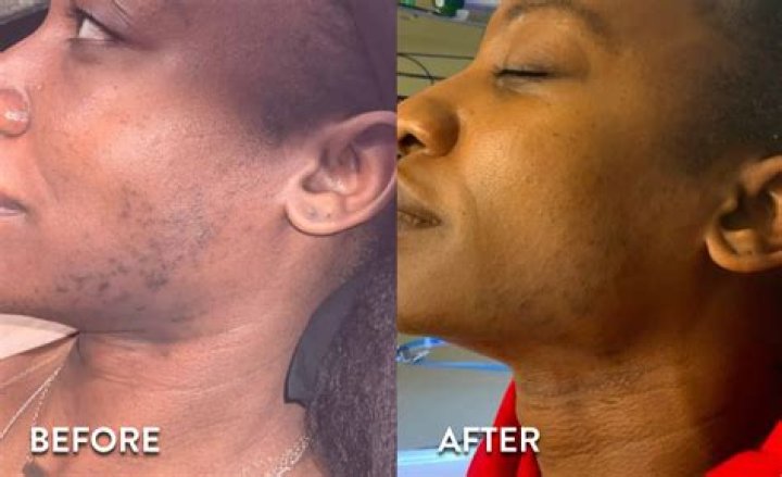 Laser horror story: Woman left with face burns after hair removal session