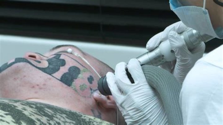 Mark Cropp had one session to remove the tattoo at Sacred Laser, which offered to do the job free. Photo / NZ Herald