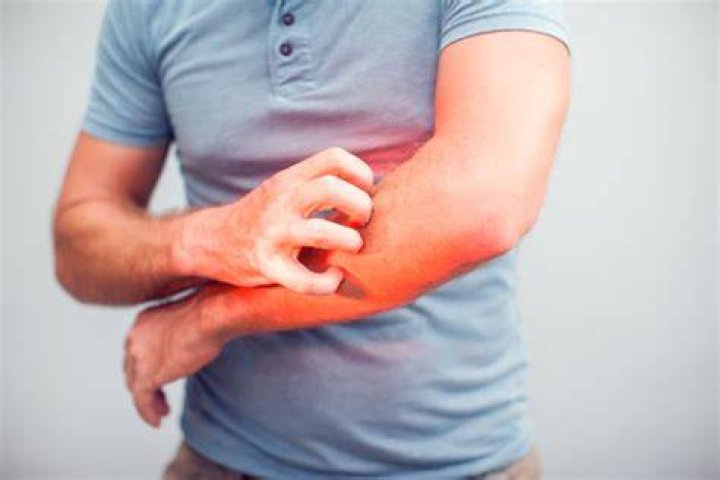 Meet the man allergic to water: Aquagenic pruritus sufferer cannot even shower