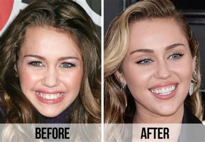 Sabrina Carpenter's Smile Transformation: The Veneers Journey