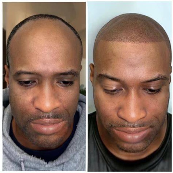 scalp micropigmentation