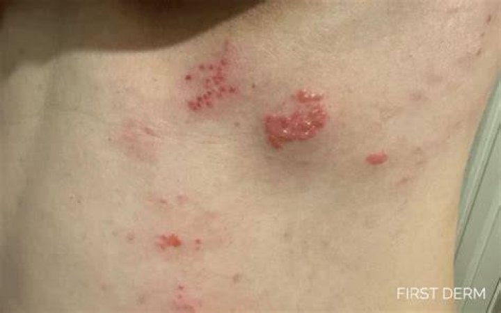 shingles