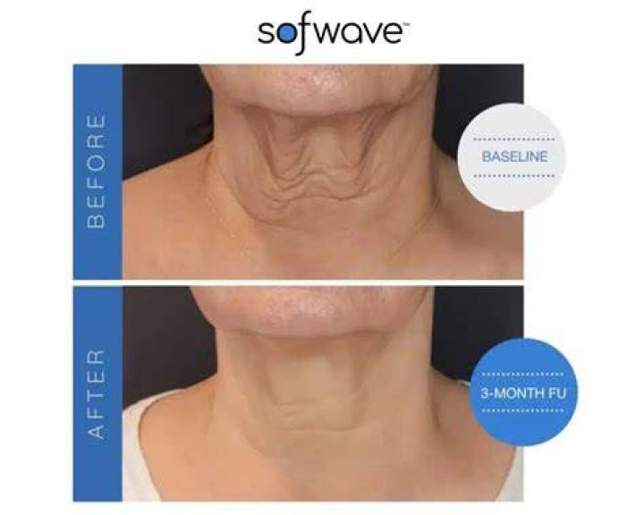 softwave skin tightening treatment review