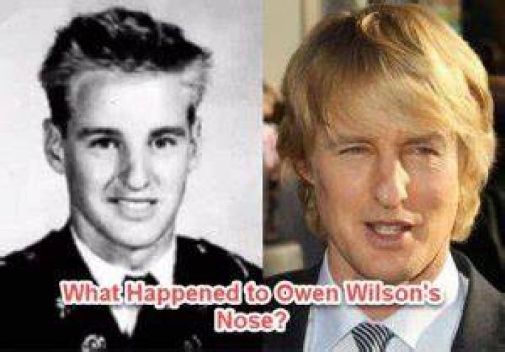 What happened to Owen Wilsons nose | Image: Pinterest