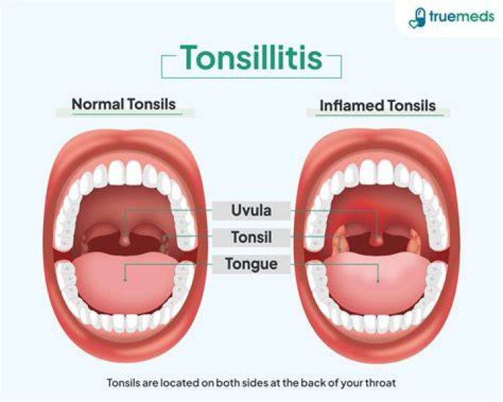 Why Is My Uvula Sticking To My Tonsil - Causes, Symptoms, and Treatment